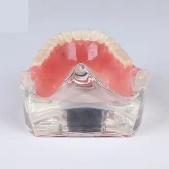 Стоматологичен Модел за изучаване на зъбите Overdenture Inferior 4 Импланти Demo Model